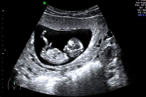 baby dating scan